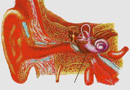 lésion oreille interne