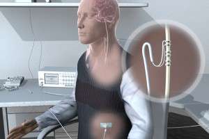Électrode de stimulation sur le nerf vague