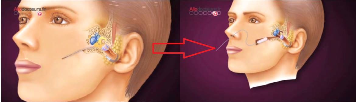 oreille débouchée
